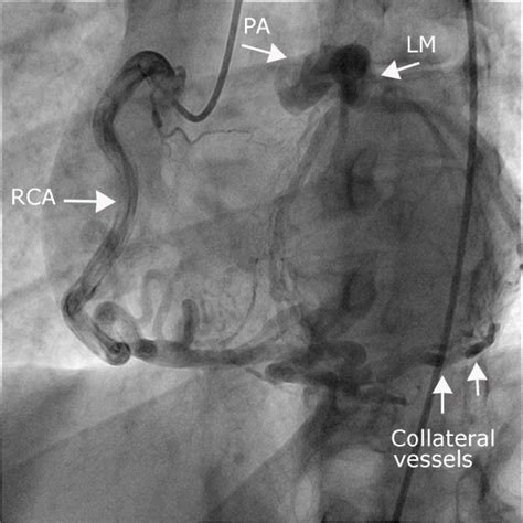 Epicardial coronary arteries are subject to damage during pericardial procedures, and often require coronary angiography to assess their proximity to the ablation catheter. Coronary angiography. Coronary angiography of the right ...