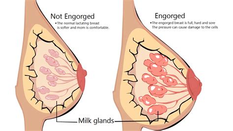 Pada awal kehidupan bayi, air susu ibu (asi) merupakan sumber nutrisi bayi yang lengkap yang diperlukan oleh bayi. 6 Cara Mengatasi Bengkak Susu, Bahaya Kalau Dibiarkan ...