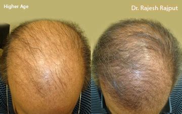 And still others choose one of the treatments available to prevent further hair loss or restore growth. Hereditary-Hair-loss-4 - Hairlossindia
