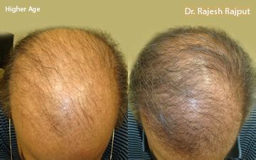 And still others choose one of the treatments available to prevent further hair loss or restore growth. Hereditary-Hair-loss-4 - Hairlossindia