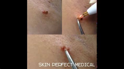 The tag band skin tag removal device is designed to work fast in removing skin tags. Virtually Painless Skin Tag Removal - YouTube
