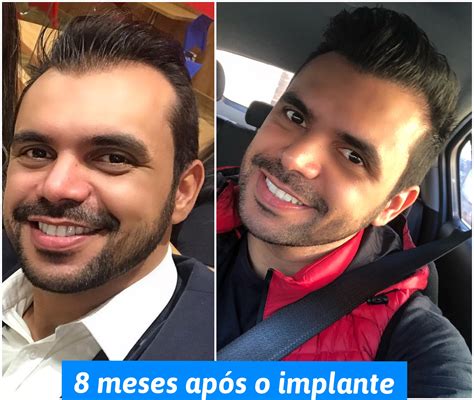 Muitas vezes, o transplante capilar é confundido com o implante capilar. O antes e depois de 7 famosos que fizeram implante capilar ...