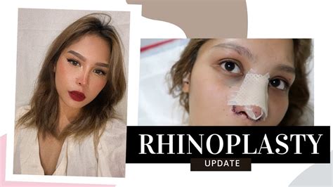 How much is the average nose job. How much is Rhinoplasty in the Philippines? (Rhinoplasty ...