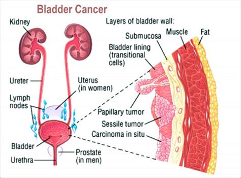 Urine that's tinged red or deep red blood in the urine (called hematuria) is one of the first signs of bladder cancer. Bladder Cancer Causes, Signs And Symptoms - Health And ...