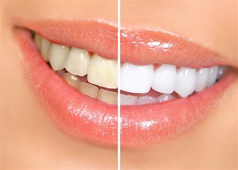 The reason you should keep the braces clean is to prevent white spot formation which are hard. 7 Tips for White Teeth - Consumer Guide to Dentistry