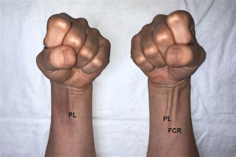 Although good wound healing after size may be incorrect. The clinical photograph showed no flexor carpi radialis (FCR) tendon... | Download Scientific ...