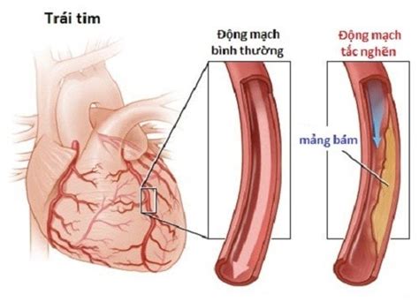 Kết quả thống nhất đá tiếp h2, cả thế giới (các trang bóng) hầu như ra 1 kết quả vẫn có thằng xồn xồn thua kèo đan mạch nhảy cửng lên, nào là trận đấu còn 5', nào là mất tinh thần, nào là delay 1h30. Bệnh mạch vành là gì? - HaNoiWard