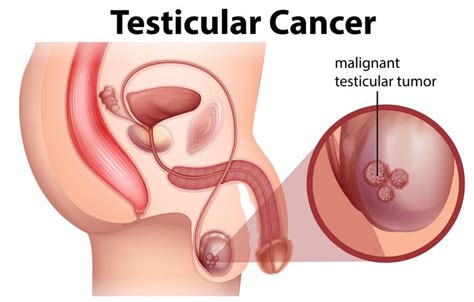 If it's caught early, testicular cancer is treatable and usually curable. A Male Anatomy of Testicular Cancer - Download Free ...