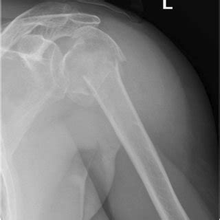 X-ray one year after implantation of reverse shoulder ...