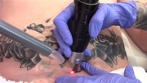 Posted on 08.33 by sirkel. PicoSure Laser Tattoo Removal Treatment - Clean Slate ...