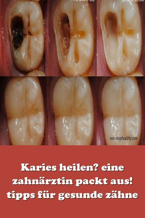 Unter anderem beeinflussen das nahrungs. Karies heilen? eine zahnärztin packt aus! tipps für ...