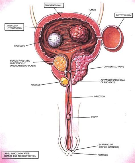 Your doctor will ask how long and how often you've been experiencing the symptom(s), in addition to other questions. Bladder Cancer - Durward Black, MD