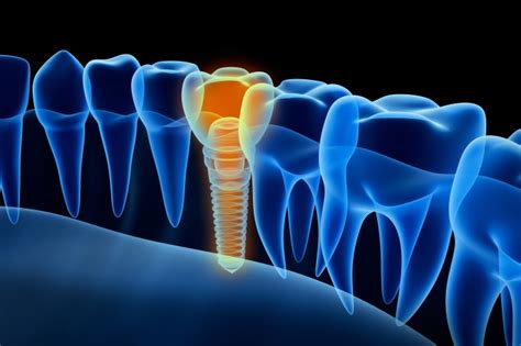 We did not find results for: Dental Implants and Sinus Perforation — JIACD JIACD