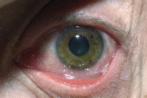 Most people in the united states are symptoms that are severe or that don't go away after 2 weeks. Herpes simplex eye infections - NHS