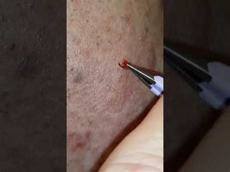 An infected ingrown hair can cause a lot of problems which can turn from a minor infection to major. #TRENDING ~ Deep Ingrown Hair Removed Fast - YouTube