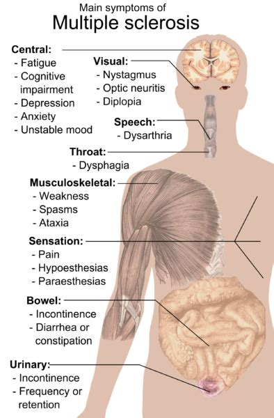 Multiple sclerosis (ms) causes damage to nerve fibers in the central nervous system. File:Symptoms of multiple sclerosis.png - Wikimedia Commons