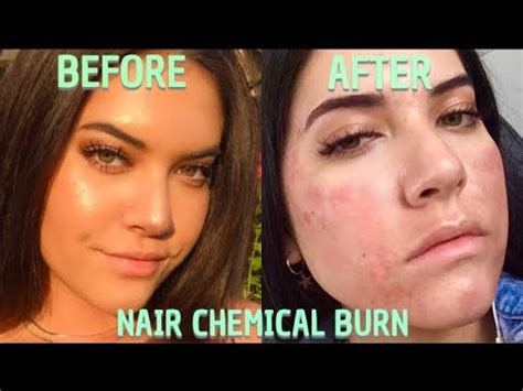 This beloved formula is created for sensitive skin, so those who are susceptible to red and irritated skin can have peace of mind while using this product. NAIR CHEMICAL BURN STORYTIME - YouTube