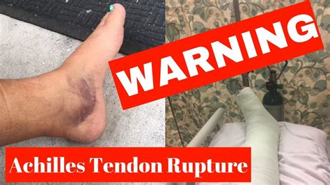 The quadriceps tendon on top of the kneecap and the patellar tendon on the underside of it make up what is known as the quadriceps mechanism. I snapped my Achilles Tendon dancing in my kitchen **OMG ...