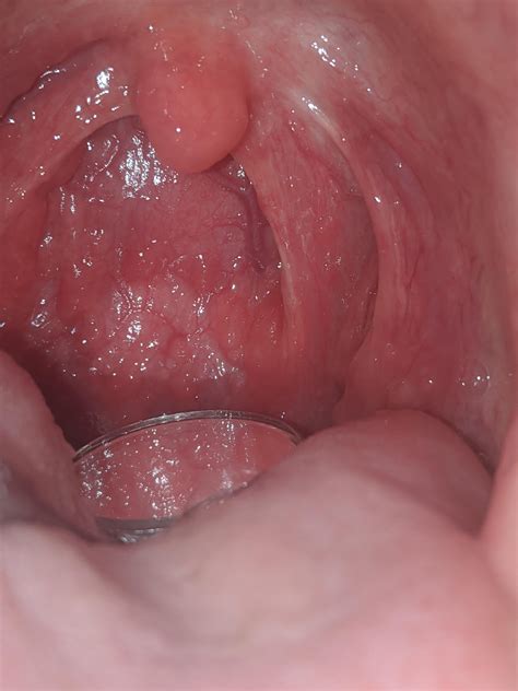 You can examine residuals in terms of their magnitude and/or whether they form. Does anyone have residual one sided throat pain ...