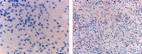 Fulminating diffuse interstitial fibrosis of the lungs. Fatal B-cell Lymphoma Following CLIPPERS | Allergy and ...