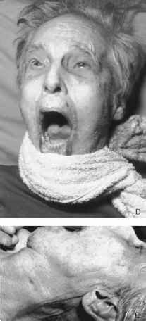 This picture shows a case of ligature strangulation where ligature mark appears to be oblique, due. Man Appears to be Screaming After Ligature Strangulation