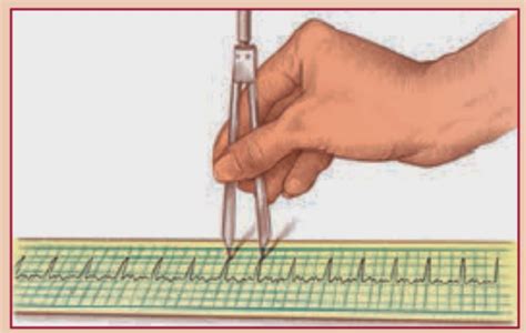 Interpretasi dasar rate frekuensi jantung normal adalah. Delapan Langkah Interpretasi Jantung