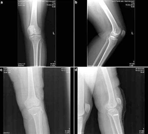 · last updated:march 8, 2021. (a) Preoperative AP X-ray of a revision case of a ...