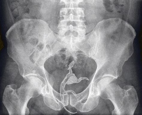 Akibatnya, tingkat kecerdasan kita akan mengalami stagnasi. Gerbil x-ray.jpg