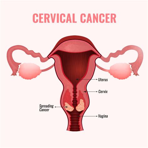 This procedure is called a cone biopsy, or conization. Cervical Cancer Diagnosis and Treatment in Thailand ...