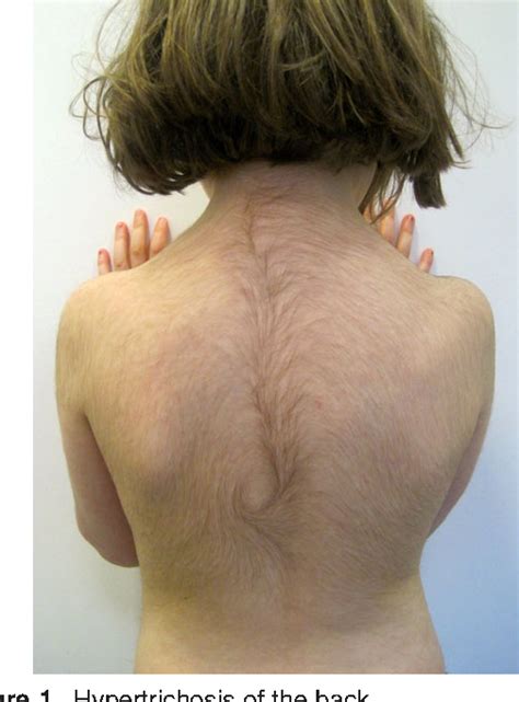 Nutritional factors and hair loss. clinical and experimental dermatology 27.5 (2002): Figure 1 from FOXN1 Duplication and Congenital ...