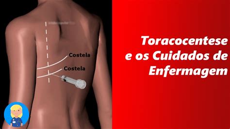 O curso de enfermagem procura, além de manter a saúde dos pacientes, fornecer habilidades para que os alunos possam atuar na recuperação da saúde humana e na prevenção de. Toracocentese e os Cuidados de Enfermagem - YouTube