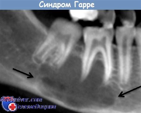 Oct 02, 2019 · hypoventilation syndrome, congestive heart failure, obstructive sleep apnea, poor blood flow to the kidneys, and; Синдром Гарре (Garre) - синонимы, авторы, клиника