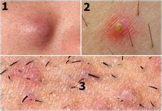 This undesirable growth pattern of a hair growing back into the skin is more likely to occur after hair removal, including shaving, tweezing or waxing. 11 Best Infected Ingrown Hair Images Infected Ingrown Hair