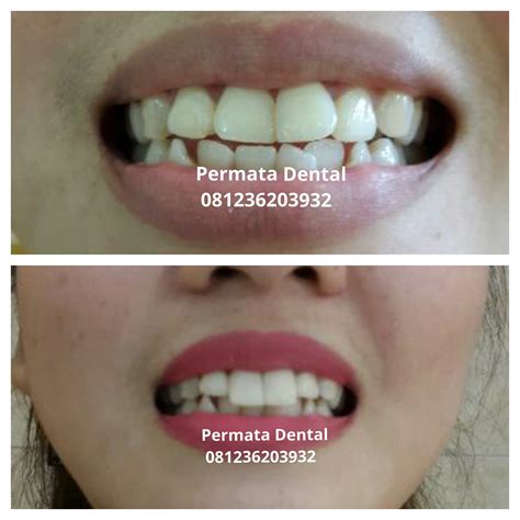 Perbedaan gigi palsu permanen dan gigi palsu biasa adalah. AHLI GIGI PALSU BALI PERMATA DENTAL