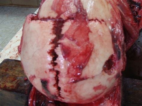 Pathologist or the police, the roles of the trauma physician and forensic. Sutural Fracture in Gunshot | Forensic Pathology Online