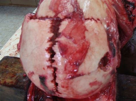 So a gunshot wound in the shoulder can impact very important internal organs that may knowing how to treat gunshot wounds is vital when shtf. Sutural Fracture in Gunshot | Forensic Pathology Online