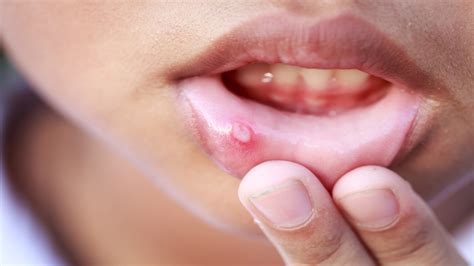Oral herpes is an infection which is very common and caused by the virus called herpes simplex. Herpes in the Mouth - Health Hearty