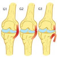 Acl tears have contributed to the shocking plummets of pga golfer tiger woods and nba guard derrick rose. MCL Tear Recovery