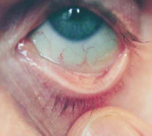 Tetapi, masalah kesehatan mata ini lebih kerap terjadi di kelopak baca juga: Macam Macam Gejala Penyakit Pada Mata - Pasien Sehat