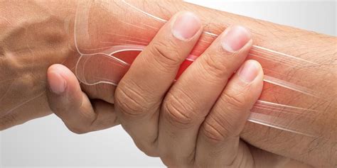 Perban elastis 7 5 cm x 4 57 m atau 3 inci untuk patah tulang keseleo tangan lutut dll biocrepe pembalut katun elastis di lapak berkahshop bukalapak. Paling Populer 10+ Gambar Tangan Terkilir - Gani Gambar