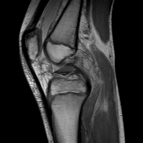 Anterior cruciate ligament avulsion fracture | Image ...
