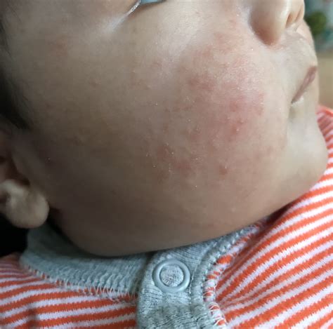 The baby may have a hormonal imbalance issue or other causes of rashes that would warrant a milia is common among newborn babies. Newborn Baby Face Acne - newborn baby