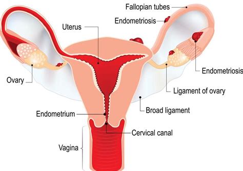 Pathogenetic implications of the anatomic distribution. Cervical Endometriosis | Fleur Women's Health Rancho Mirage