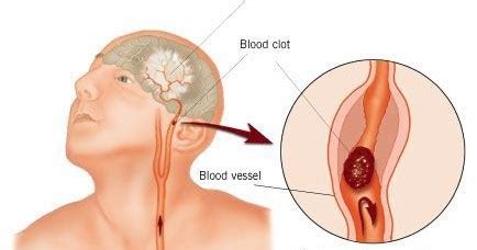 Masih banyak kaum muda yang menyepelekan penyakit stroke. Cara Terapi Stroke Ringan di Rumah - mastimon.com