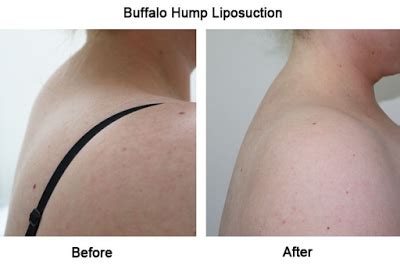 14 tips on how to prevent camel toe. How To Get Rid Of A Buffalo Hump | Buffalo hump, Neck hump ...