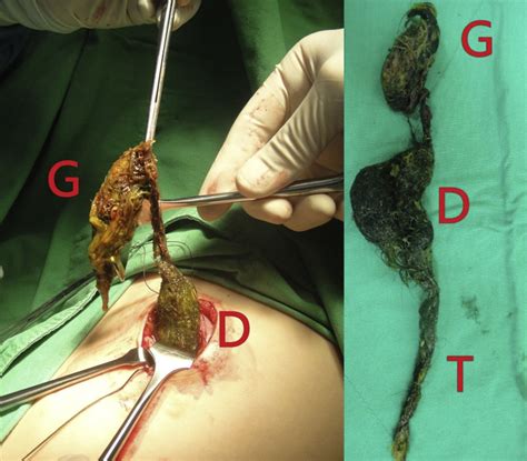 A bezoar is a gastrointestinal condition caused by undigested material. A gastric bezoar with a connection stalk to another larger ...