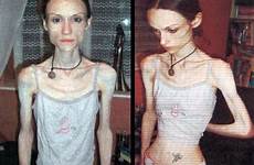 anorexia bulimia disorders