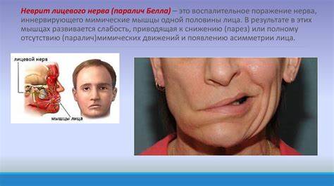 Диета лицевого неврита Неврит лицевого нерва - презентация онлайн Неврит лицевого нерва - презентация онлайн Диета лицевого неврита