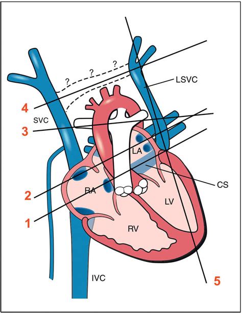 Anomalies of Systemic and Pulmonary Venous Connections | Obgyn Key