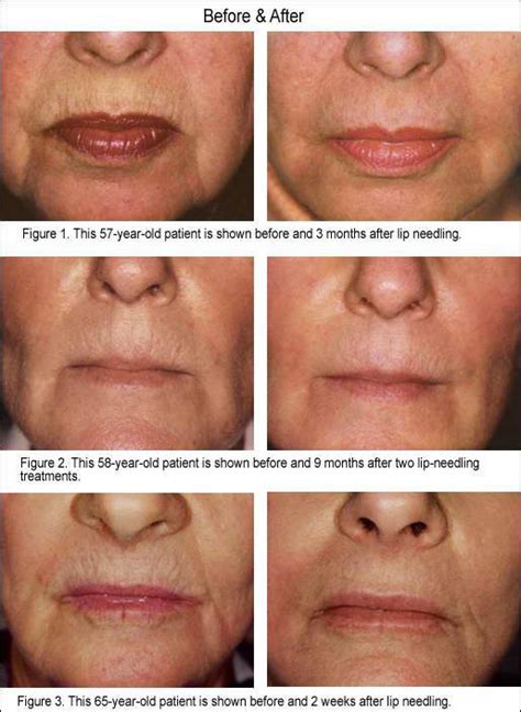 After you've learned this, their role in your life is over. Before and after Dermapen treatments at Cheshire Lasers ...